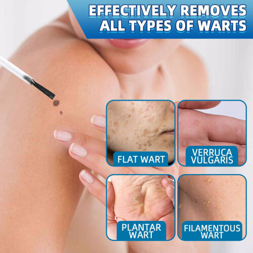 iBeaLee Skin Tag Remover Fast Effective Safe 20ml. 2