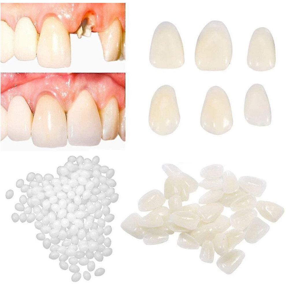 Temporary Tooth Repair Kit For Filling The Missing Broken Tooth And Gaps-moldable Fake Teeth