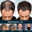 Hair Regrowth 5% Extra Strength Topical Hair Loss For Men Solution 4