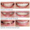 Smile Snap On False Teeth Upper Lower Dental Veneers Dentures Tooth Cover Set 3