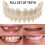 Smile Snap On False Teeth Upper Lower Dental Veneers Dentures Tooth Cover Set 1