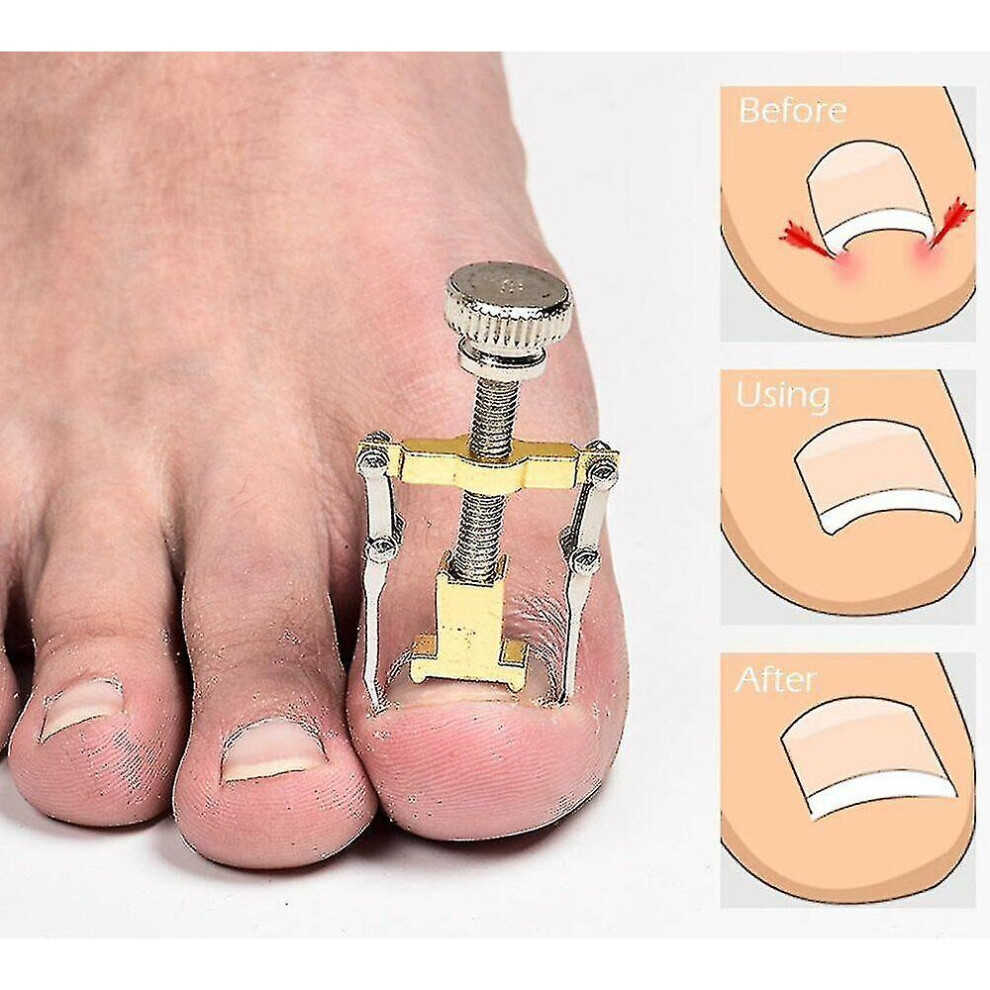 Ingrown Toenail Manicure Pedicure Foot Care Correction Brace Tool Toe Clipper