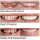 Smile Snap On False Teeth Upper Lower Dental Veneers Dentures Tooth Cover Set 4
