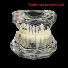 Dental Model Teeth Implant Restoration Bridge Teaching For Study Tooth Science