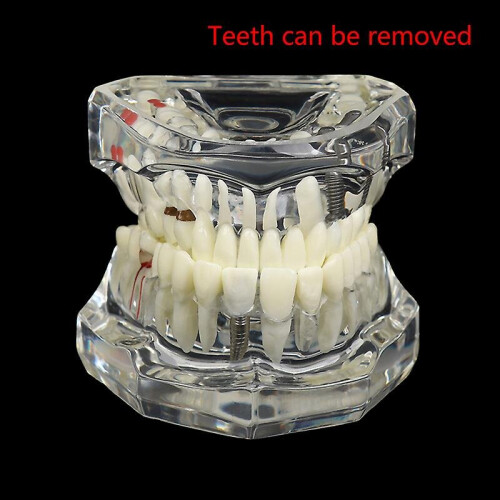 Dental Model Teeth Implant Restoration Bridge Teaching For Study Tooth Science