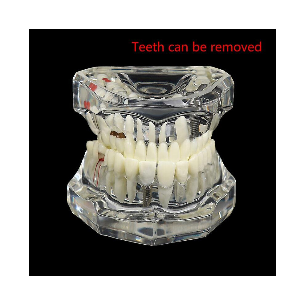 Dental Model Teeth Implant Restoration Bridge Teaching For Study Tooth Science