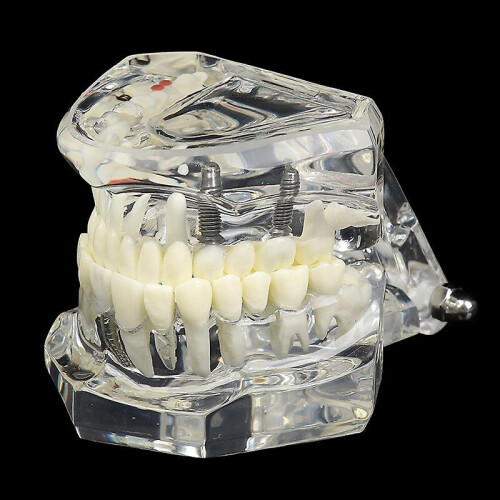 Dental Model Teeth Implant Restoration Bridge Teaching For Study Tooth Science 1