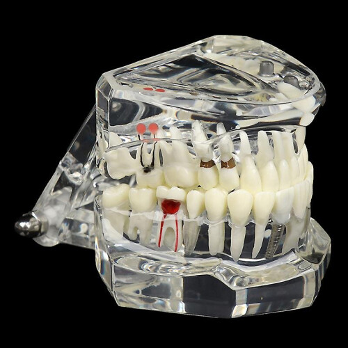 Dental Model Teeth Implant Restoration Bridge Teaching For Study Tooth Science 2