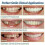 Smile Snap On False Teeth Lower 2