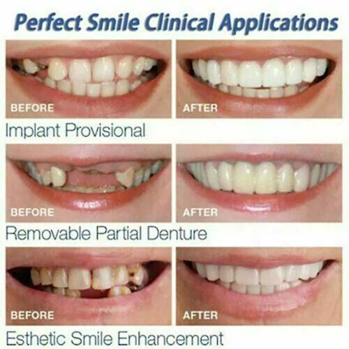 Smile Snap On False Teeth Lower 1