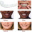 Upper/lower Comfort Fit Flex Whitening Denture Braces 2