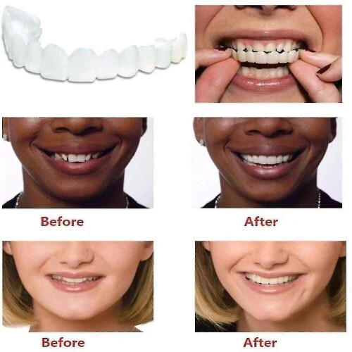 Upper/lower Comfort Fit Flex Whitening Denture Braces 1