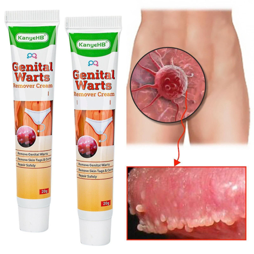 Wart Remover Cream Genital Wart Treatment Remover 1