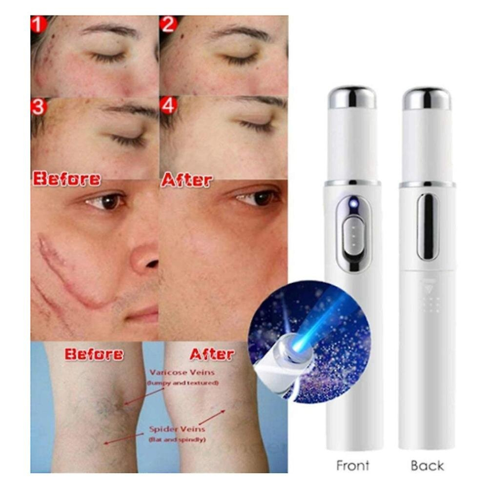 Blue Light Therapy Pen For Spider Veins Acne Removal Pen Scar Wrinkles Puffy Eyes Dark Circles Removal Pen