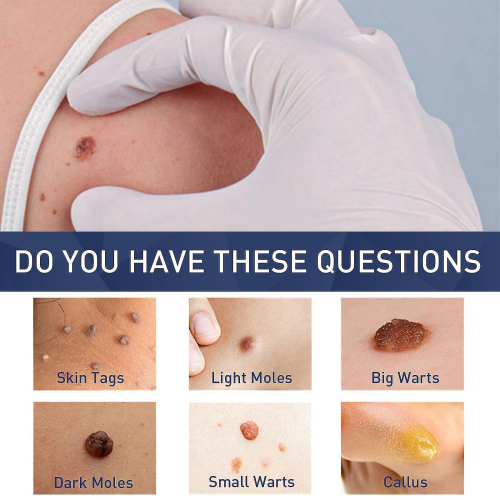 Hpv Remover  Wart Remover  Fast-acting 1