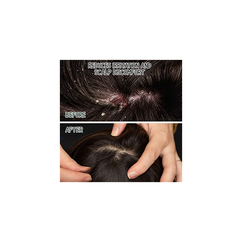 Pine Tar Shampoo for Seborrheic Dermatitis 500ml Natural Dandruff