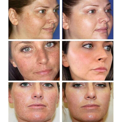 Ibealee Cream Remove Melasma Cream Remove S Melanin Melasma Remover Skin 2