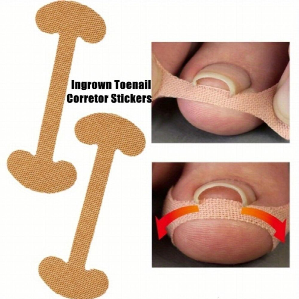 20PCS Professional Glue Toenail Correction Strips Health Foot Care Ingrown Toenail Corrector Patch