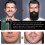 Beard Roller,540 0.5mm Needles/derma Roller Hair Growth Beard Roller For Growth For Men Microneedle Roller(roller Set) 4