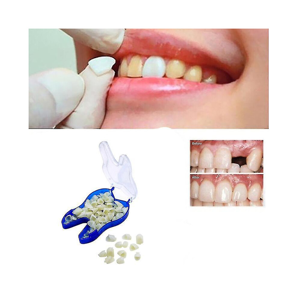Temporary Dentures Occlusal Upper Dentures, Veneers, Missing Teeth, Broken Teeth And Interdental Spaces, Front Teeth   Back Teeth