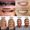 Artificial Teeth Dentures Temporary 4