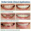 Smile Brace Snap On Upper False Teeth Dental Veneers Denture Cover Set 2
