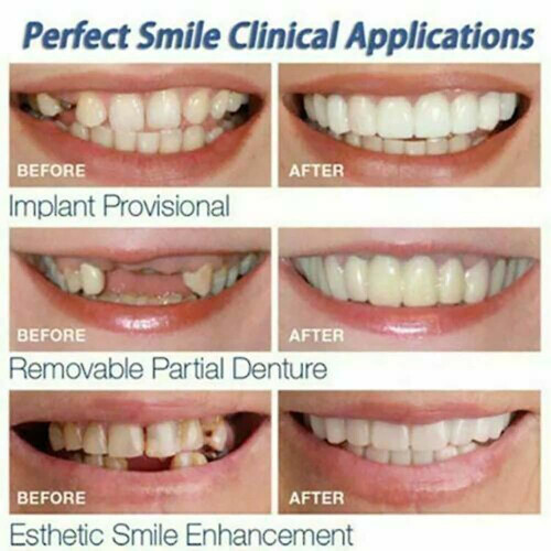 Smile Brace Snap On Upper False Teeth Dental Veneers Denture Cover Set 1
