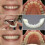 Smile Brace Snap On Upper False Teeth Dental Veneers Denture Cover Set 4