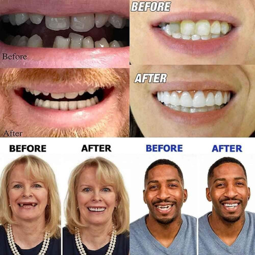 Artificial Teeth Denture Top Perfect Smile Veneer 1