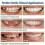 Smile Snap On False Teeth Lower 2