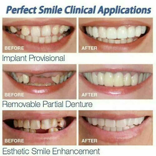 Smile Snap On False Teeth Lower 1