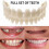 Smile Snap On False Teeth Upper Lower Dental Veneers Dentures Tooth Cover Set 1
