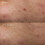 Dermalogica Deep Breakout Liquid Patch 5