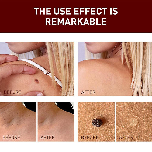 2pcs Wipe Off Tags And Mole Remover, Skin Tag Remover Liquid, Effectively Remove Skin Tags 1