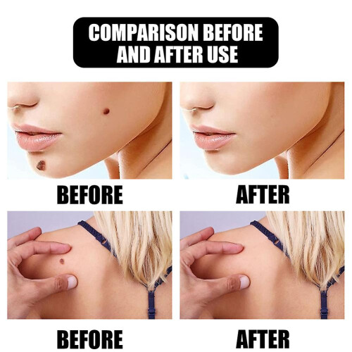 (2pcs) 1-3pcs Fast Removal Skin Tag Mole Wart Remover Liquid Wipeoff Tags 1