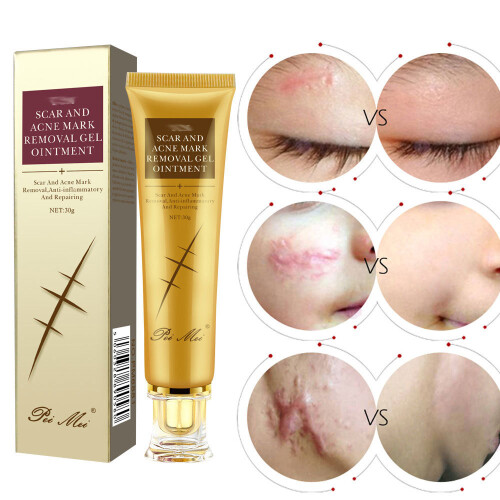 Scar repairing removing Scar cream 2