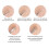 4PCS Blackhead Remover Pimple Comedone Extractor Tool Acne Kit 6