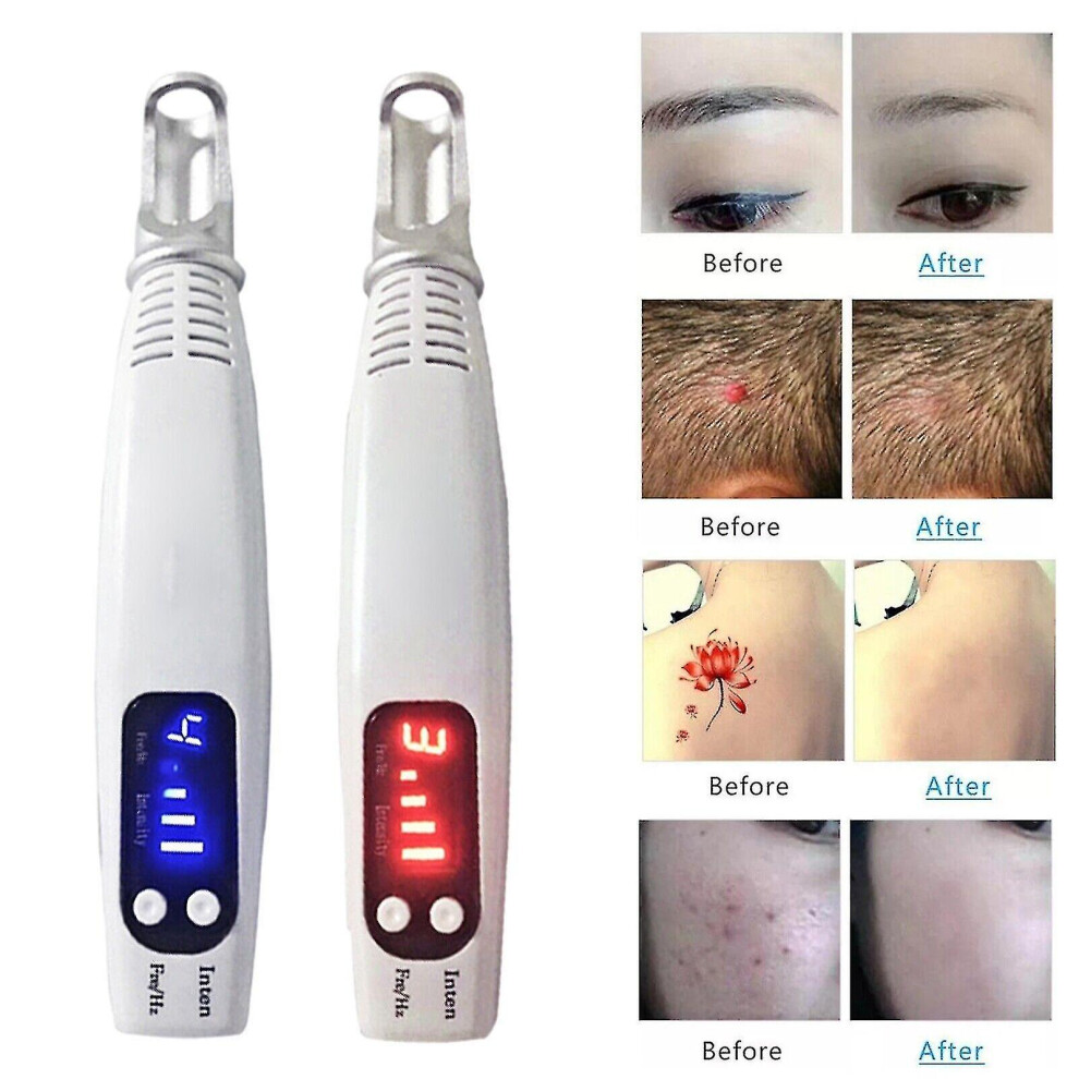 Home Portable Picosecond Tattoo Removal Pen Fit For Mole Dark Spot Acne Scar