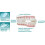 Secure Comfort Teeth Grinding Guard for Moderate Grinders. 3