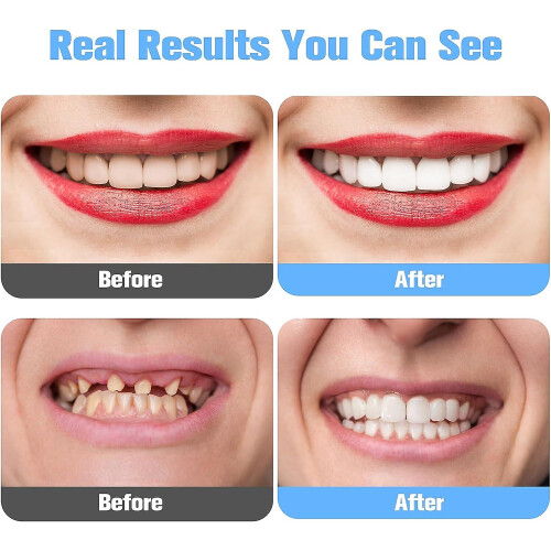 Veneer Dentures Set, 2pack Upper And Lower False Teeth, Bright White Shade, Comfortable 1
