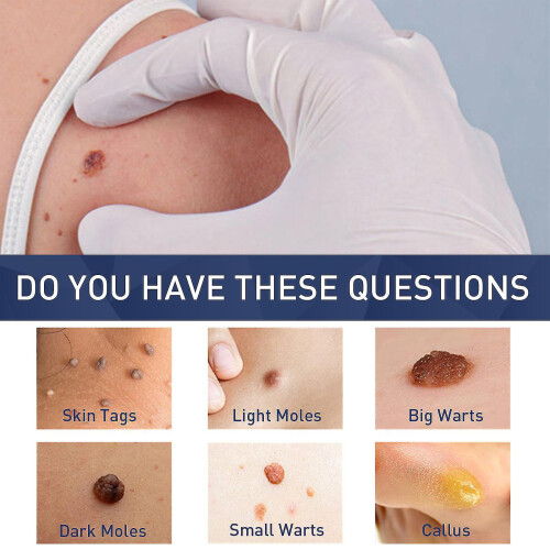 Hpv Remover  Wart Remover  Fast-acting 1