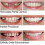Dentures Tooth Cover Set-yky 3