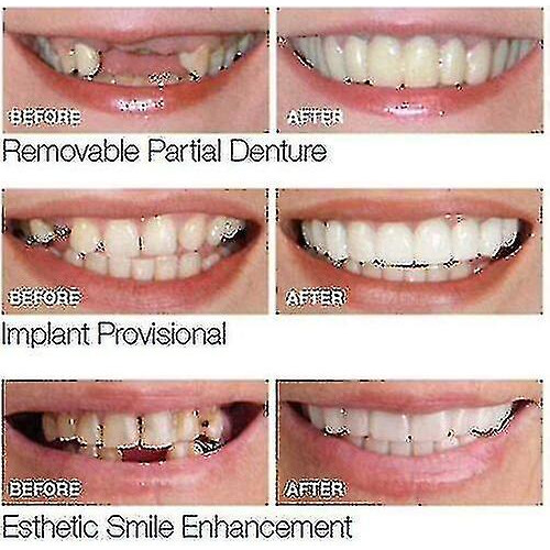 Dentures Tooth Cover Set-yky 2