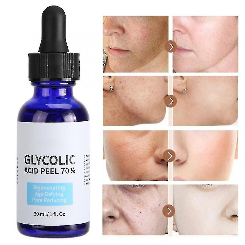 Glycolic Acid Peel Purity 70% Concentration 5% Skin Repair Invisible Pores Brighten Skin Tone Treat Acne Mild And Non-irritating