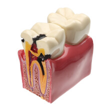 Caries Tanden Vergelijkingsmodel Tandheelkundige Studie Educatie Demonstratie