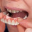 Extra Thin Fake Bright White Tooth Veneers Silicone Soft Safe Adhesive Denture Hide Shade Braces Comfortable Teeth Orthodontic 1