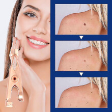 (1pc) Wart Removal Sterile Clip Professional Wart Remover Multipurpose Dark Moles Removal Clamp