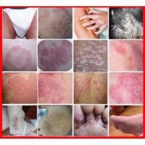 15g Herbal Eczema & Psoriasis Relief Ointment 1