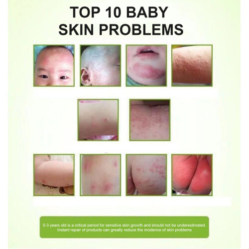 15g Herbal Eczema & Psoriasis Relief Ointment 2