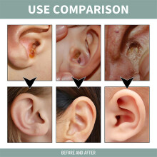 Anti Tinnitus Earwax Removal Spray Ear Wax Remover Cleaner For Tinnitus Relief